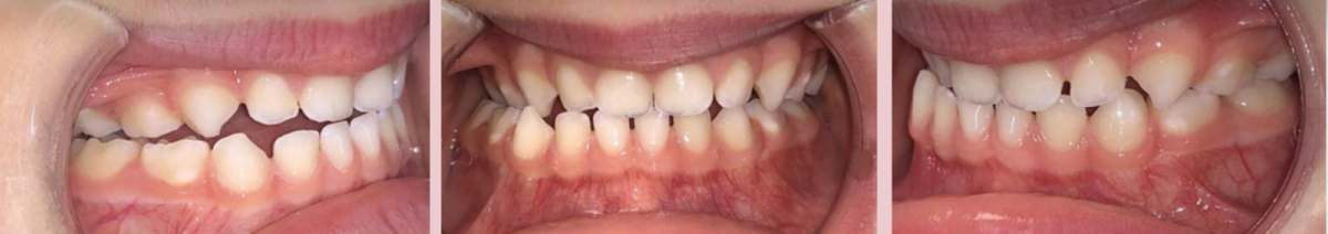 Клинический случай Доктора Самама (Dr. Samama), Франция.