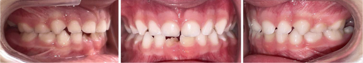 После 6 месяцев ежедневного ношения FroggyMouth - 15 минут в день.