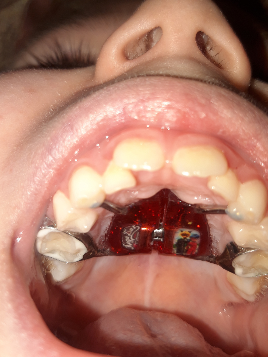 На мой взгляд, очень компактно и эстетично. Врач сказала, что на нижней части платина нам не нужна, после того, как верх достигнет нормы, низ тоже примет соответствующие размеры.