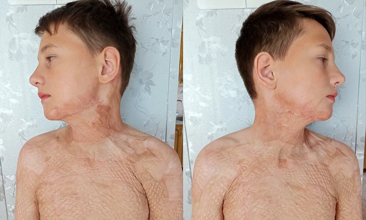 Егор Васильев, подопечный фонда «Алёша»