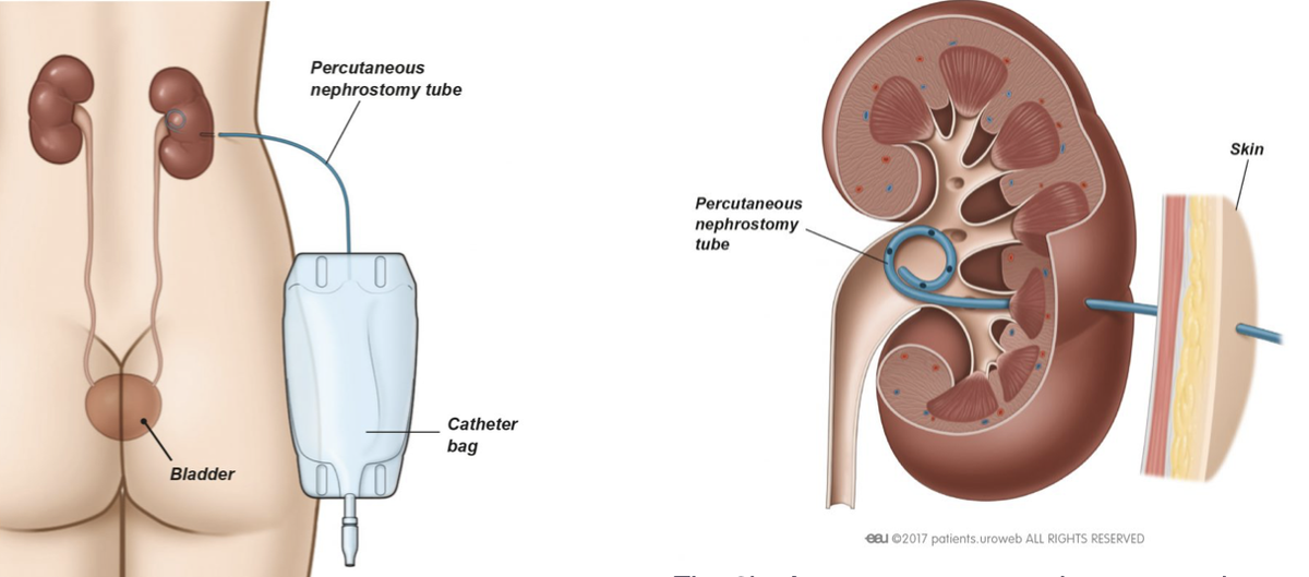 Слева общий вид: почка, нефростома и мочеприемник.  Справа: нефростома справа в почке.