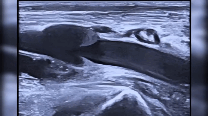 Так выглядит венозный клапан в реальности на УЗИ. Прекрасно видно как справа налево течет кровь внутри вены, кровь проходит створки клапаны и они закрываются, предотвращая обратный заброс.