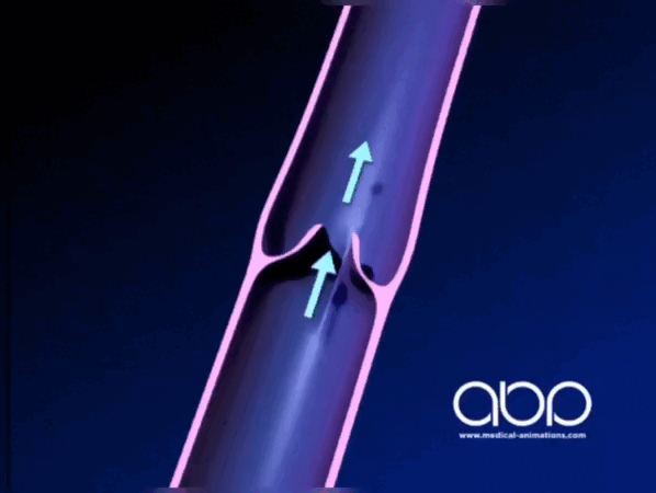 Видео с 3D моделью имитирующей работу венозного клапана в норме. Стрелкой указан нормальный поток крови по направлению к сердцу