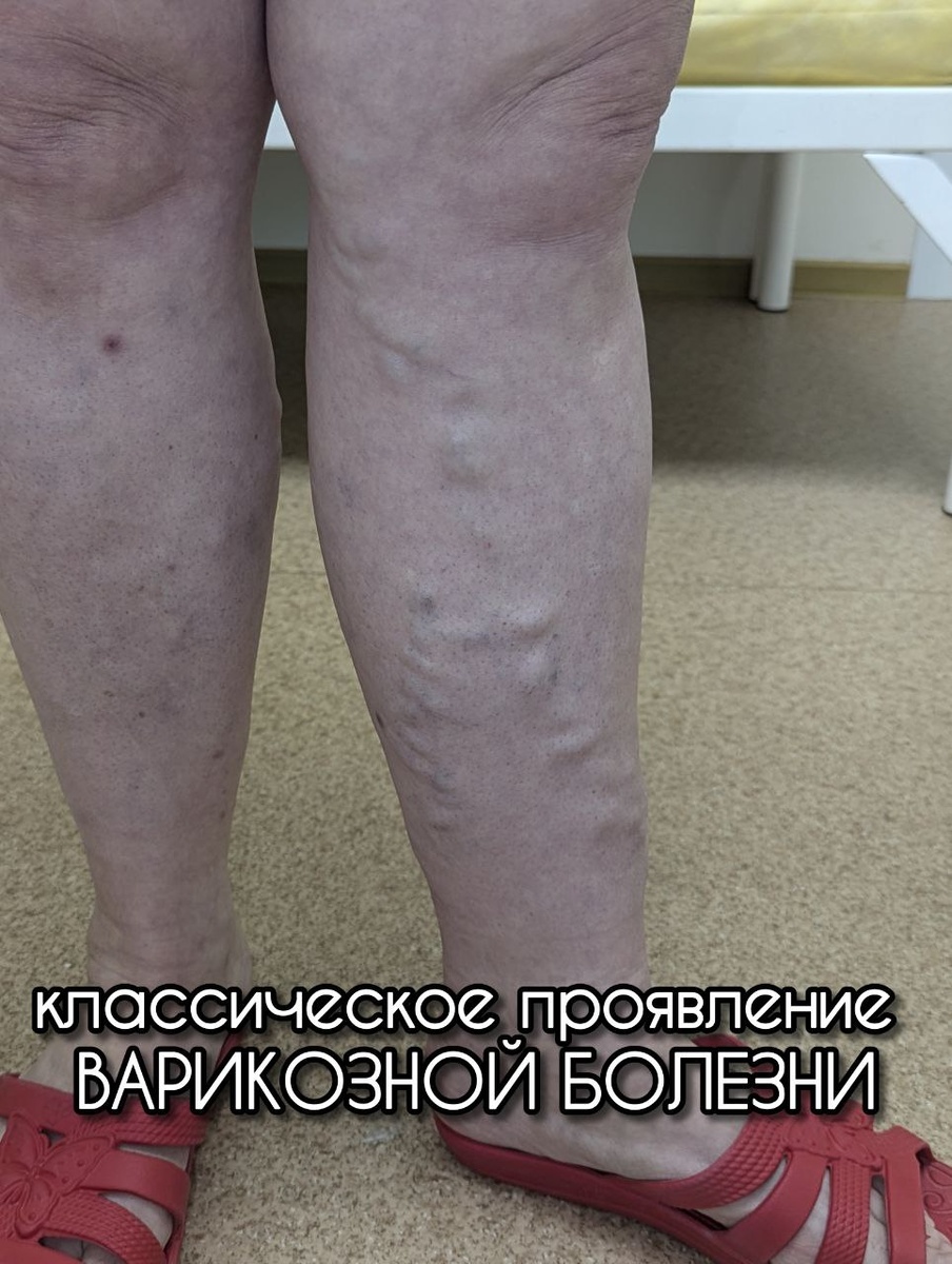 Фотография с варикозными венами (синоним: варикозные узлы). Видим расширенные извитые вены