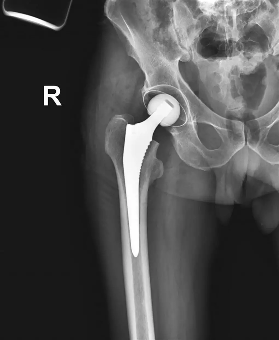 Эндопротез тазобедренного сустава