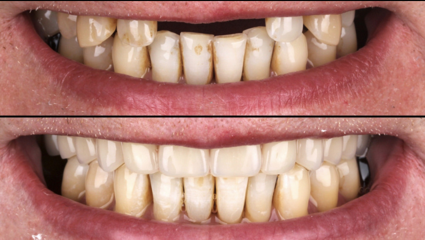 До/после лечения 