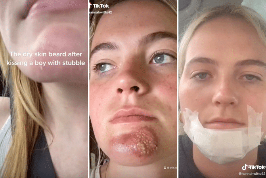 После поцелуев с бородачами у девушек может портиться кожа на подбородке