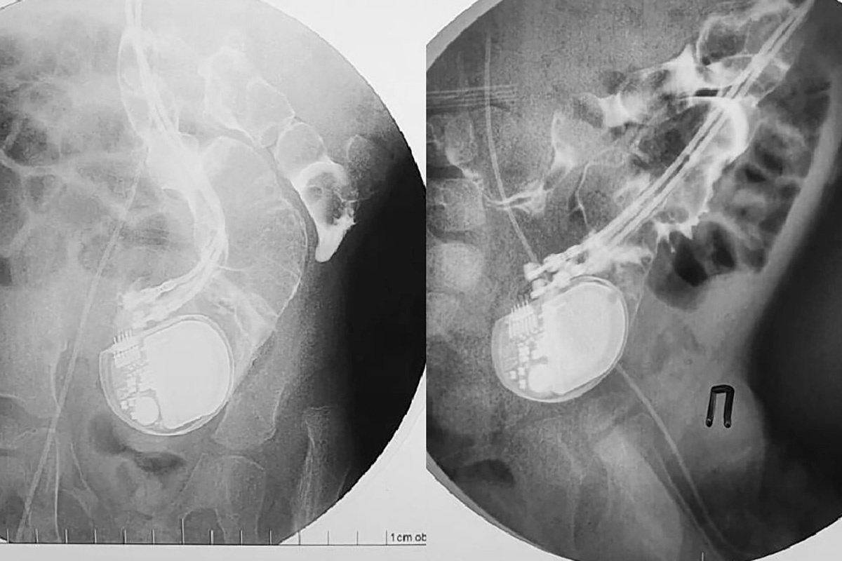 meshalkinclinic / Telegram📷Кардиостимулятор в кишечнике трехлетнего мальчика