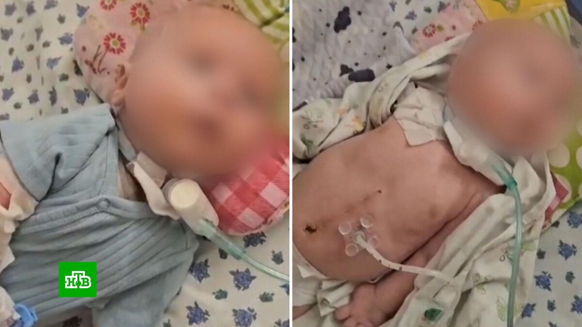    «Выдавливали ребенка»: в крымском роддоме врачи делают из детей инвалидов