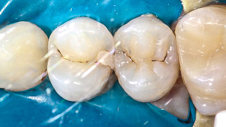 Зубы 2.4 и 2.5 ДО 