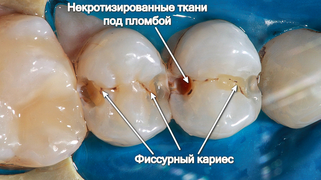 Зубы 2.4 и 2.5 после снятия пломб
