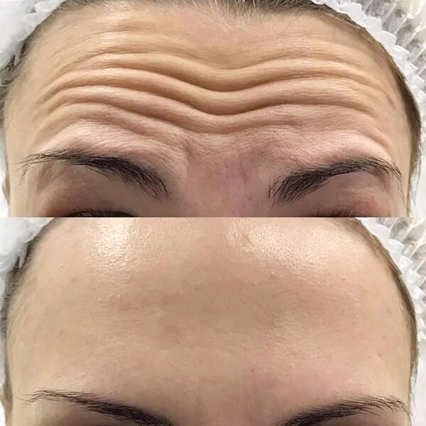 Ботокс на лбу до и после. Фото: pinterest