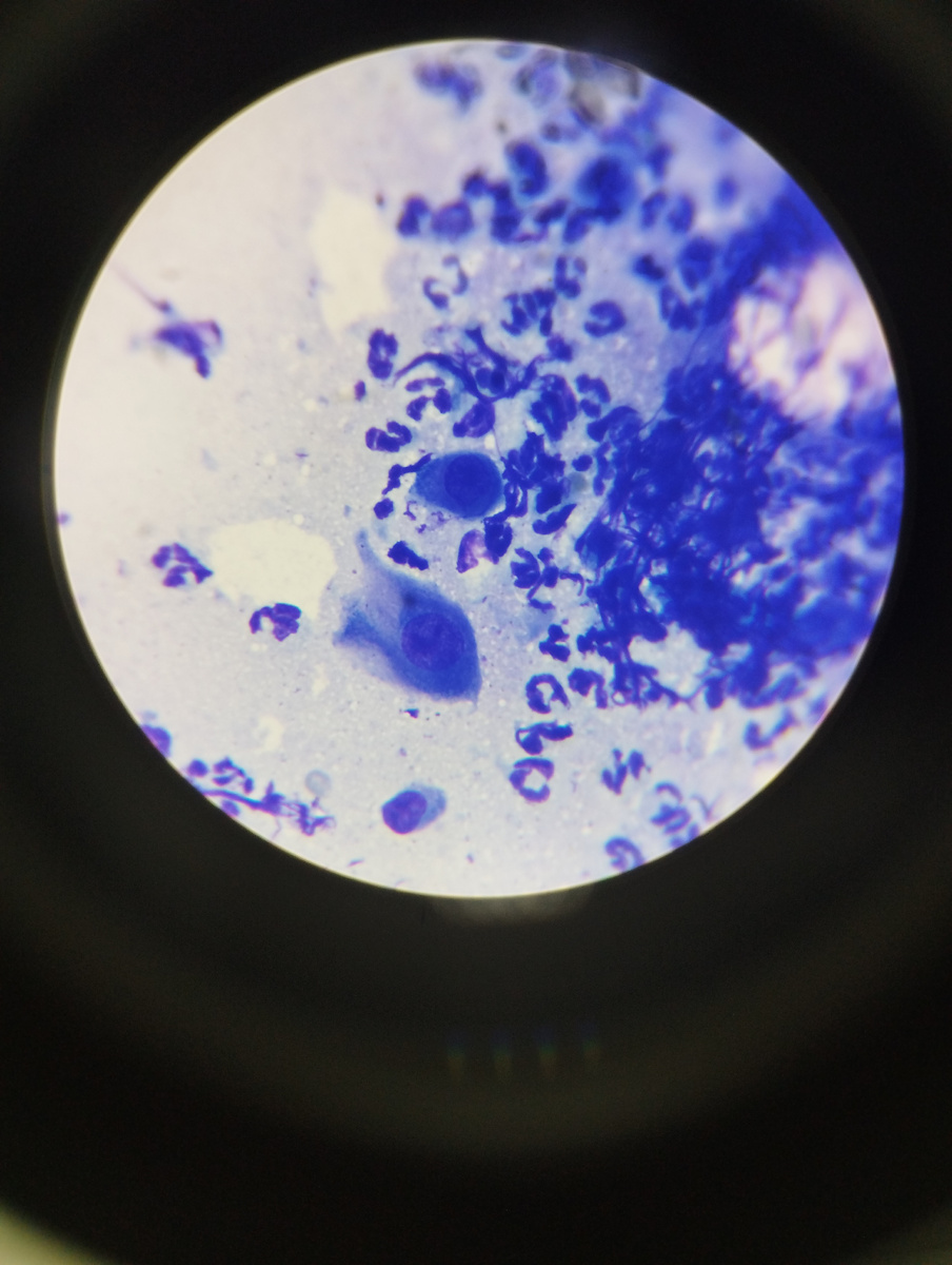 Акантоциты. 