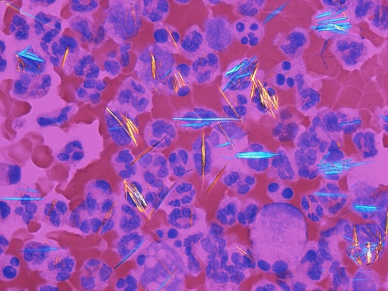 Кристаллы моноурата натрия.