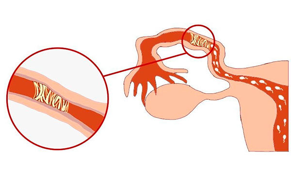 Спайки в маточных трубах при эндометриозе