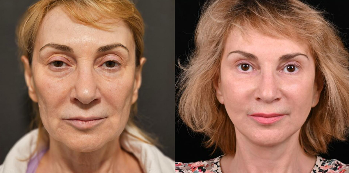 Пластика лица и шеи MACS-lift, липофилинг средней зоны лица. Фото до и после. Фото с сайта хирурга Д.Р. Гришкяна. Имеются противопоказания, требуется консультация специалиста