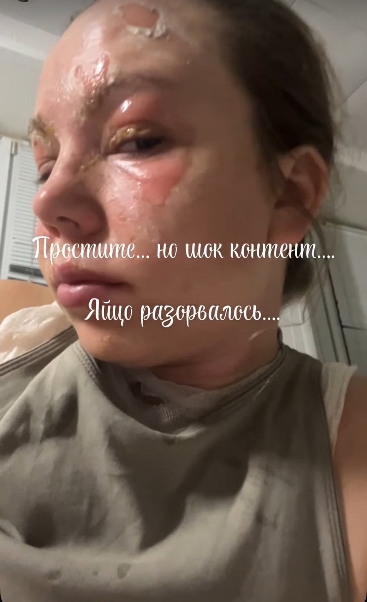 Это я уже в палате, решила выйти в сторис, так как очень многие соседи видели , что я сажусь в скорую и начали писать и звонить.