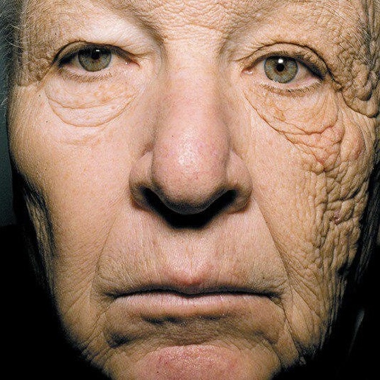 Известная всему миру фотография, опубликованная в журнале The New England Journal of Medicine, на которой изображен 69-летний дальнобойщик, который 28 лет своей жизни провел за рулем. За эти 28 лет одна часть его лица постоянно подвергалась воздействию солнечного излучения, в поврежденной стороне кожи замечен нарушенный синтез коллагена и явное фотостарение кожи. 
