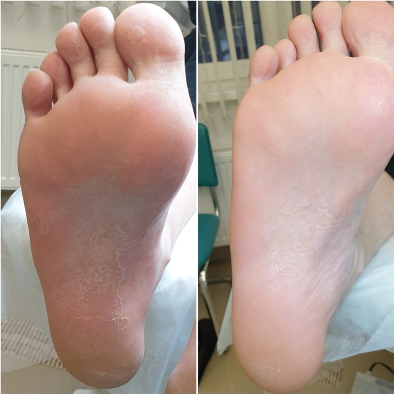 До и после обработки