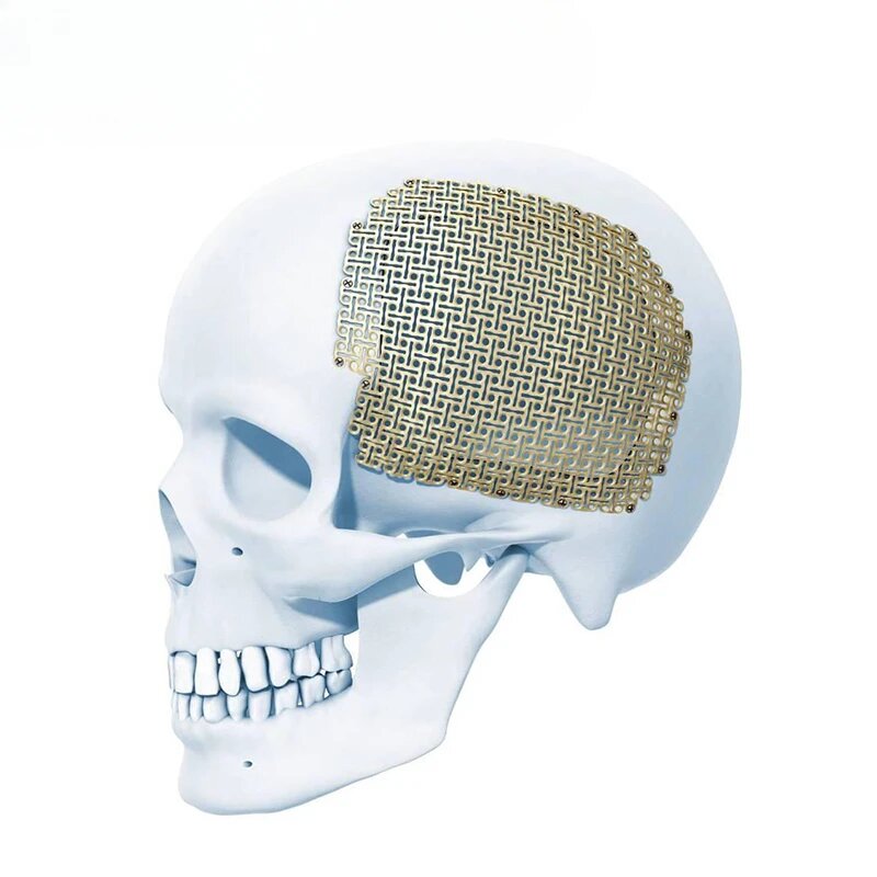 Стандартная титановая сетка для краниопластики