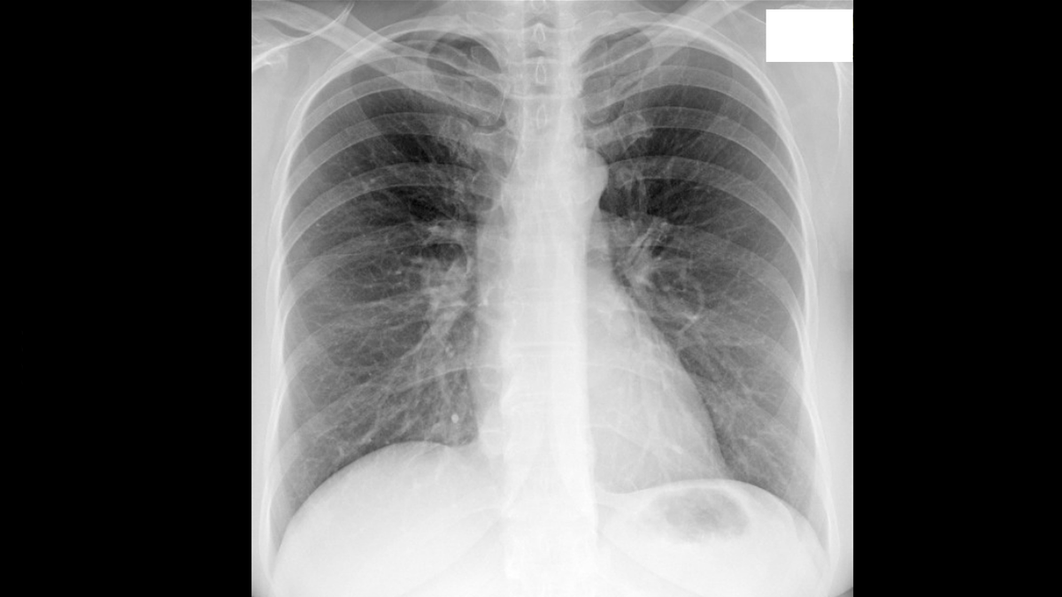 Флюорография. Осень 2023 года.