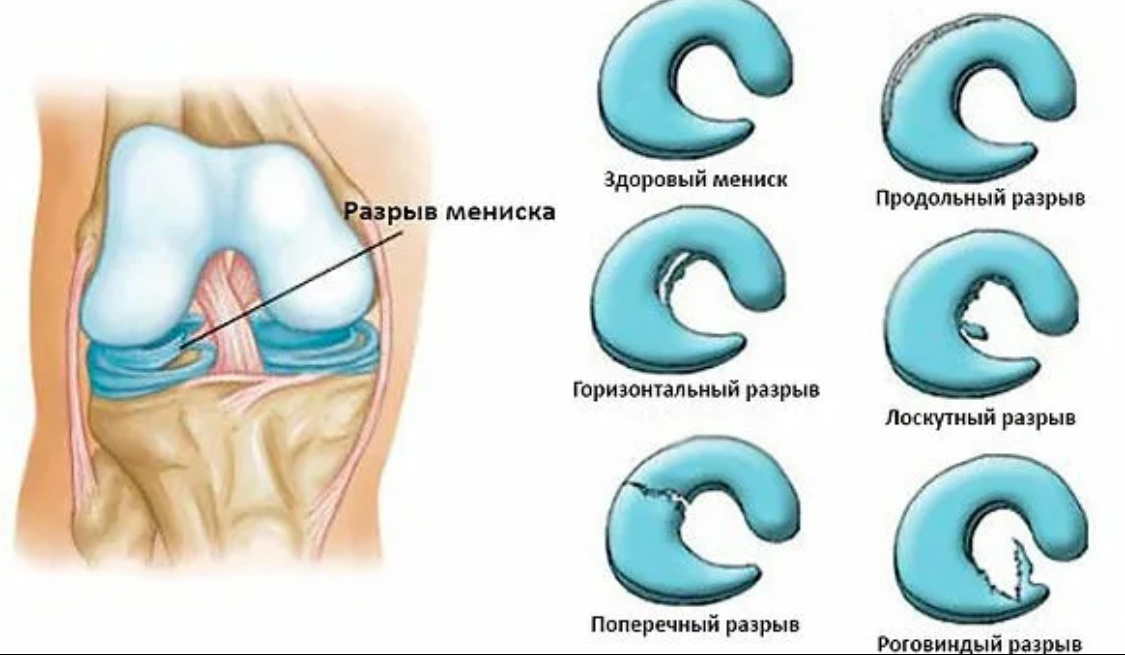 Варианты разрывов менисков