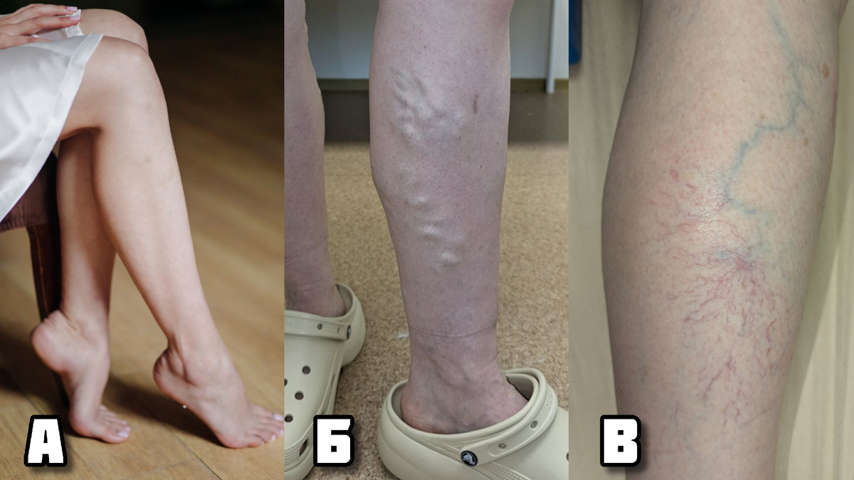 Думаю, не требуется быть врачом, чтобы предположить отсутствие заболеваний на фотографии А, наличие варикоза на фотографии Б и наличие сосудистых звёздочек на фотографии В