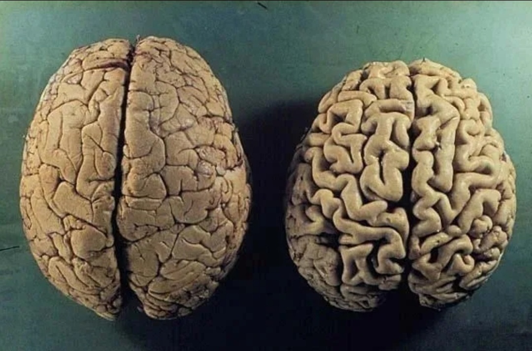 Слева изображен мозг здорового человека, справа — болезнь Альцгеймера.
