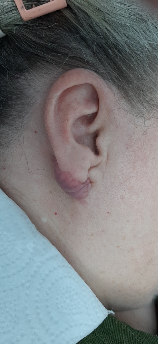 На фото келлоид мочки правой ушной раковины, имеющий достаточно чёткую границу. Келлоид частично распространяется на кожу головы, но на фото это практически не видно. Мочка уха уменьшена в размерах и деформирована после ранее проведенных операций.