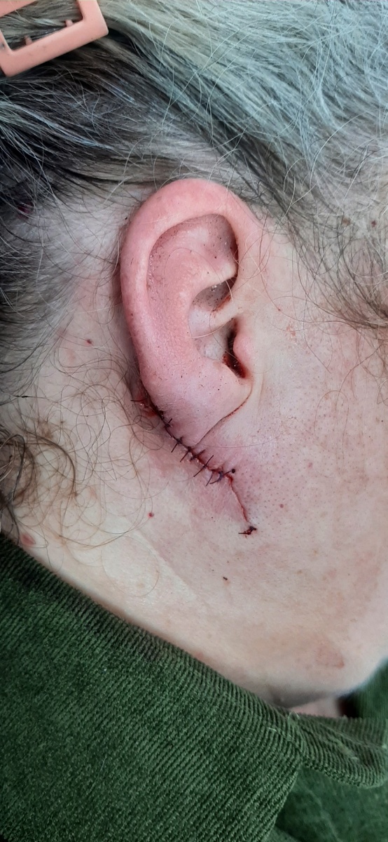 На фото состояние непосредственно после операции. Теперь мочка ушной раковины как бы плавно переходит в кожу ниже неё. Видна тонкая линия косметического шва и 2 узла на коже. Выше - мелкие узловые швы. Использовался одноразовый атравматический шовный материал для микрохирургии (не причиняет дополнительных травм тканям при проведении иглы, т. к. игла не имеет ушка, а нить впаяна в иглу. Игла и нить очень тонкие, размер их невелик, поэтому работа с таким материалом требует использования специальной увеличивающей оптики).