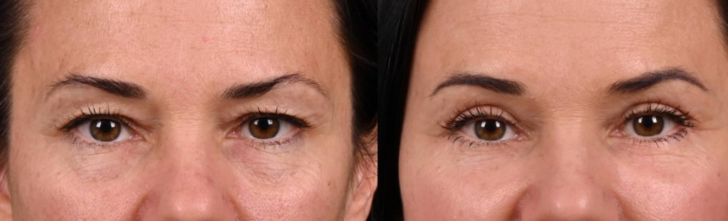 Трансконъюктивальная блефаропластика нижних век для чего нужна процедура и какой результат можно получить