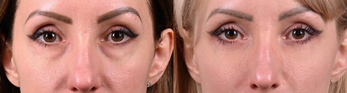 Трансконъюктивальная блефаропластика и липофилинг век фото до и после. Фото с сайта хирурга Д.Р. Гришкяна. Имеются противопоказания, требуется консультация специалиста