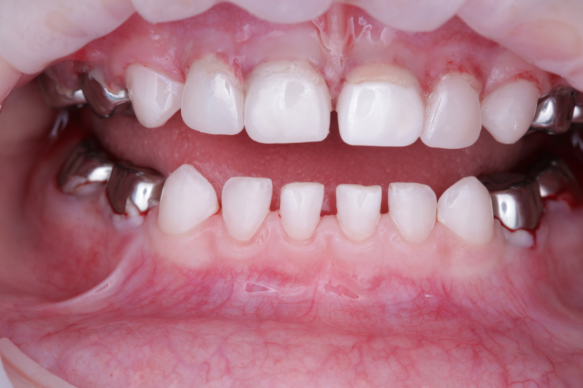 Вылеченные в наркозе зубы