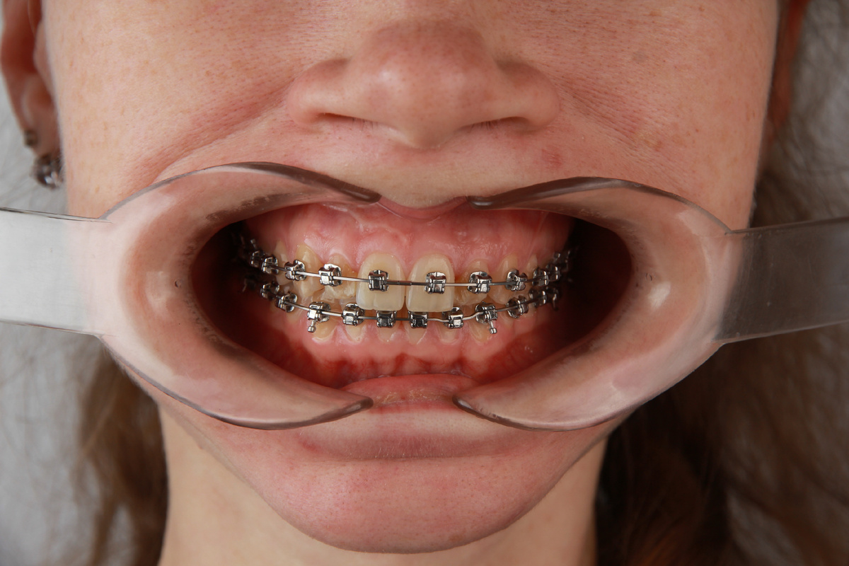 Кейс пациентки: ортодонтическое лечение.