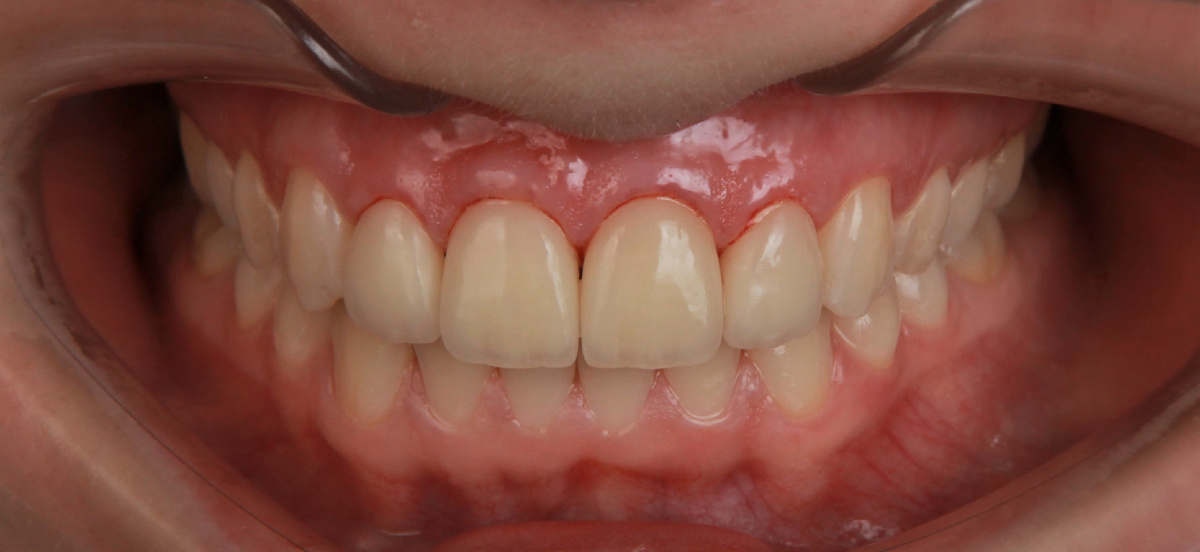 Кейс пациентки: сразу после установки виниров.