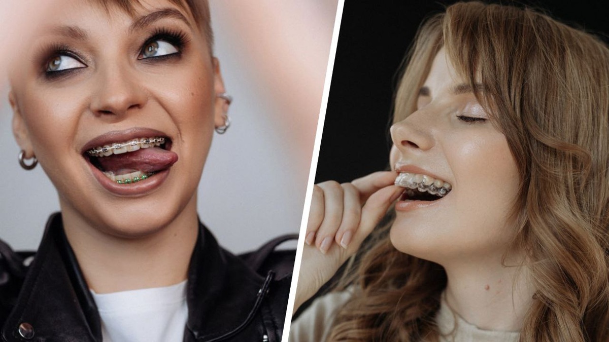 Брекеты или элайнеры?