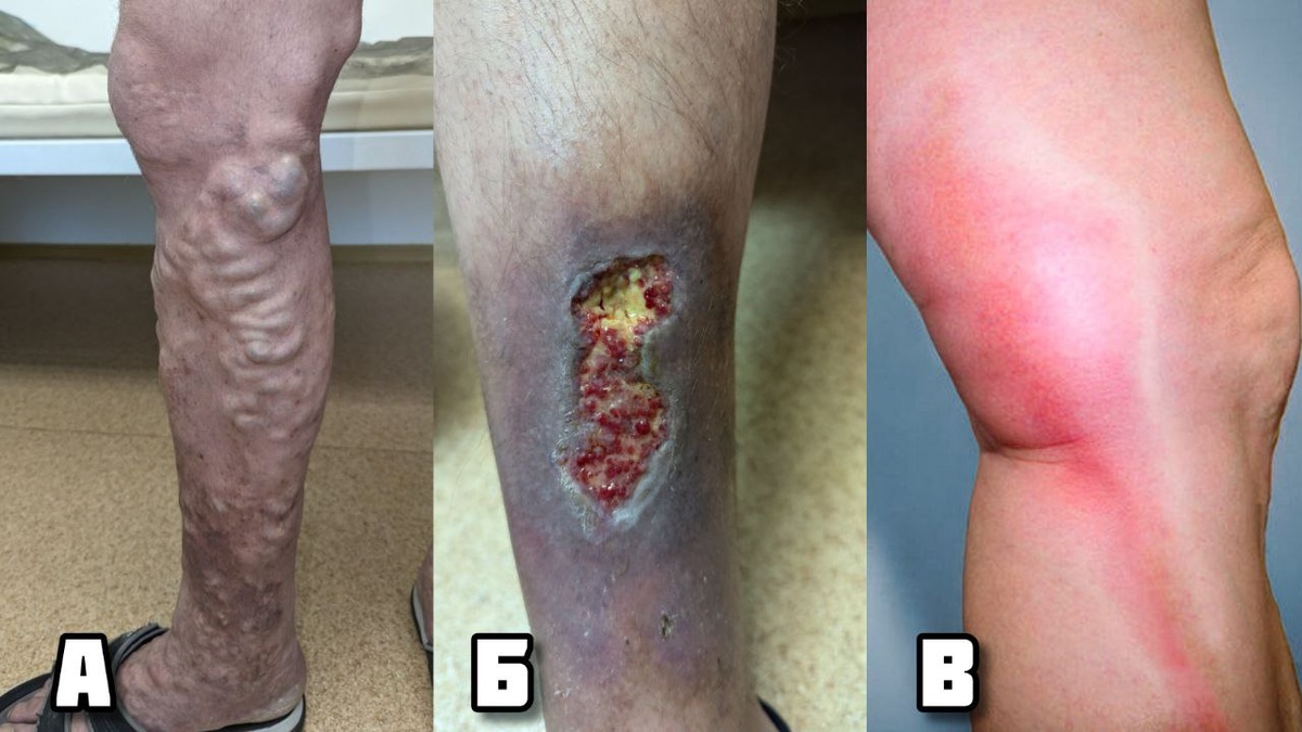 А - у пациента было два эпизода кровотечений из выраженных варикозных вен (буквально, вены лопались и кровили); Б - варикозная язва у молодого человека 35 лет (из-за варикоза участок кожи на голени выгноил); В - тромбоз поверхностных вен сопровождается краснотой и болями.