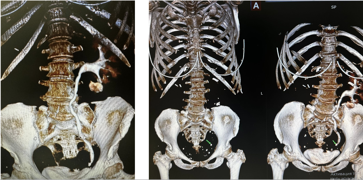 Камень в единственной почке - история пациентки.