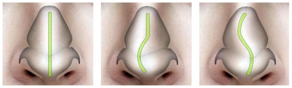 Искривление носовой перегородки: когда нужна операция?
