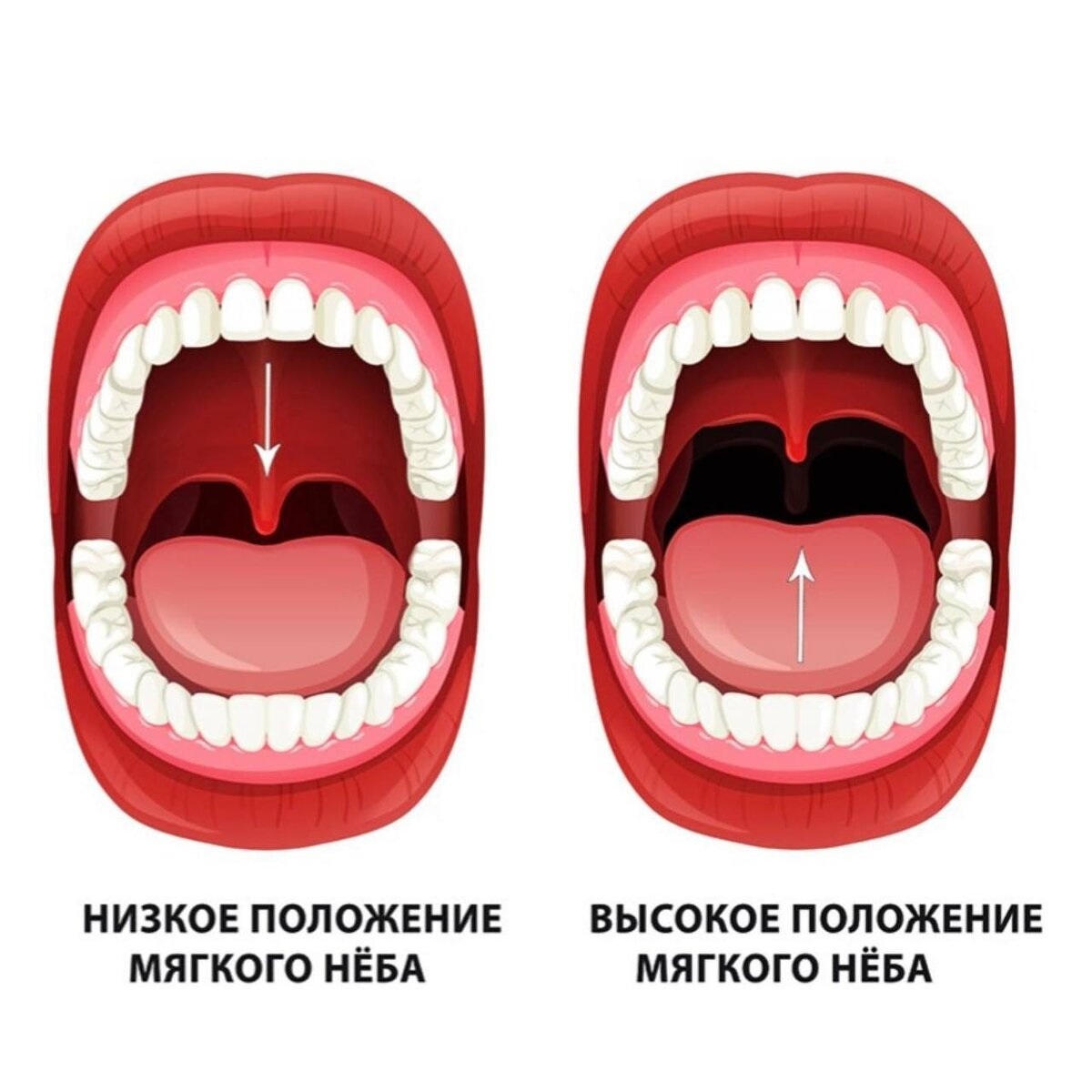 Поднятие мягкого нёба
