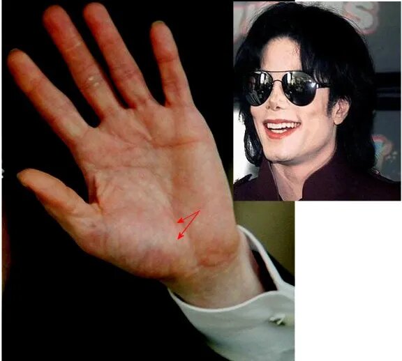 Рука Майкла Джексона. Зашоренность невооруженным взглядом видна.