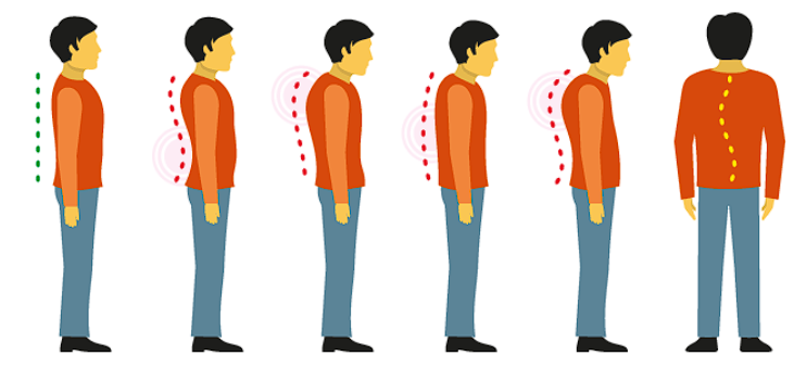 Типы осанки