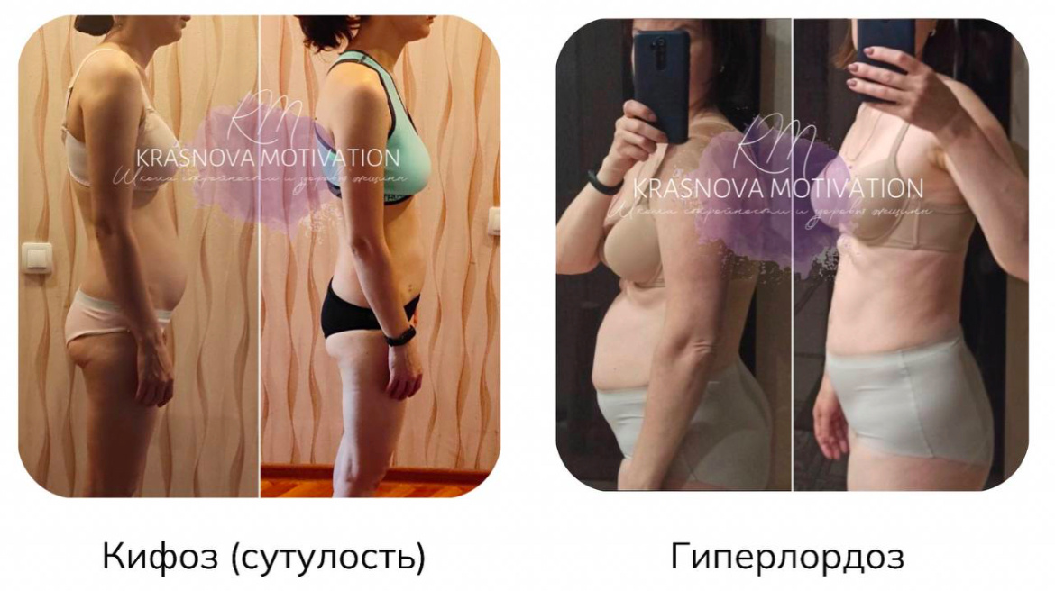 Для наглядности как осанка влияет на живот, а живот в свою очередь влияет на здоровье малого таза