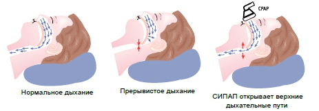 Храп и апноэ сна: тихие убийцы вашего здоровья