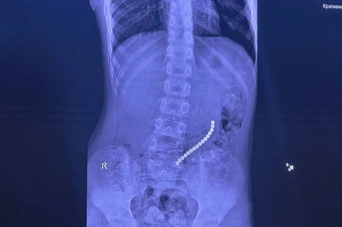    Съевшего шариковые магниты 8-летнего мальчика спасли иркутские хирурги