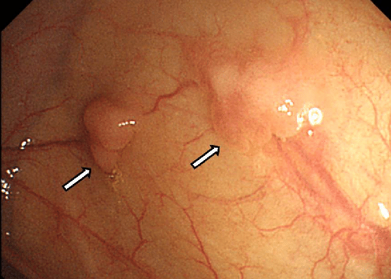 Стрелки указывают на полипы толстой кишки