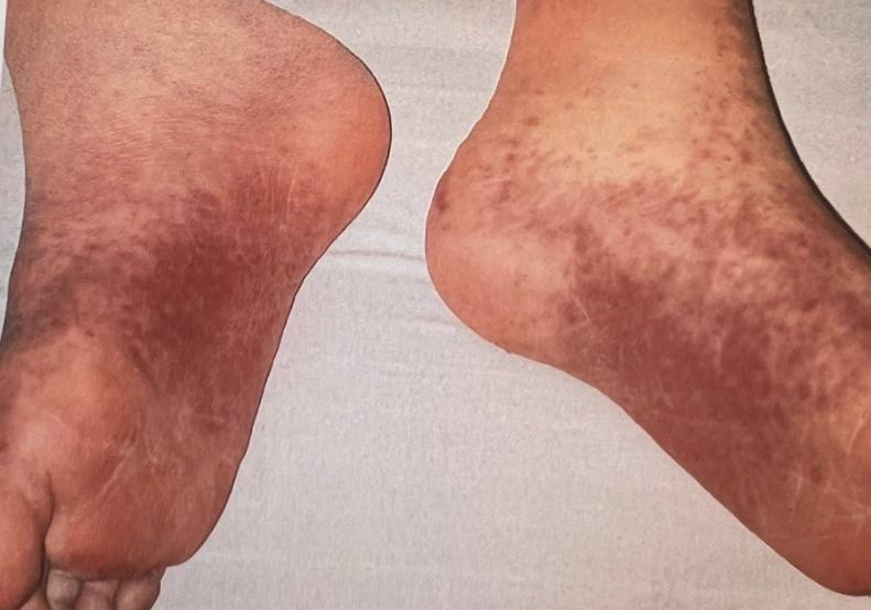 Синдром «перчаток и носков». Акральная локализация папул и пурпуры.