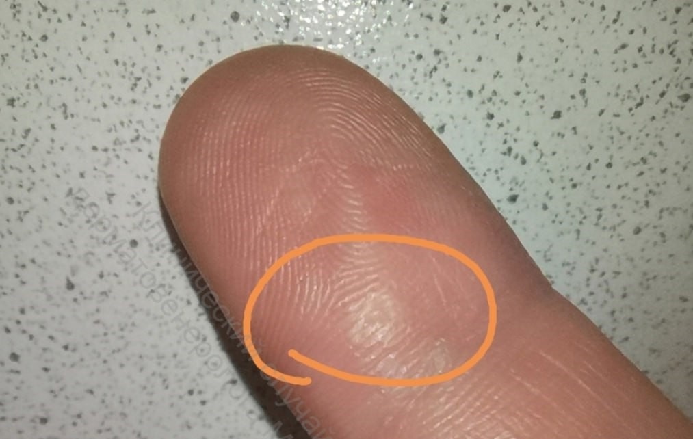    Врач работает с вирусными бородавками много лет, от пациентов не заражался, а в спортзале - практически сразу