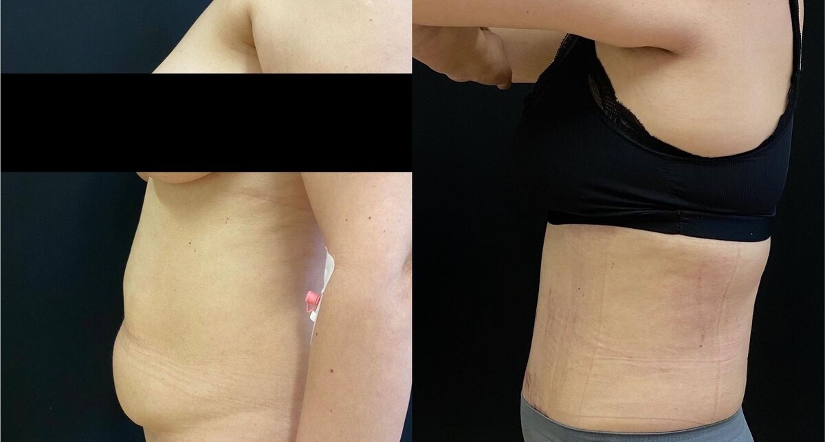Спустя 1 месяц после абдоминопластики и липосакции спины, боков.. Ещё присутствуют отечность, следы от компрессии. Фото до и после. Фото с сайта хирурга Д.Р. Гришкяна. Имеются противопоказания, требуется консультация специалиста