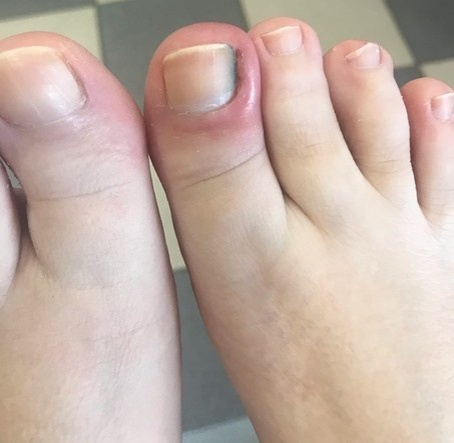 Рис.1. Стадия местного воспаления, отёка тканей